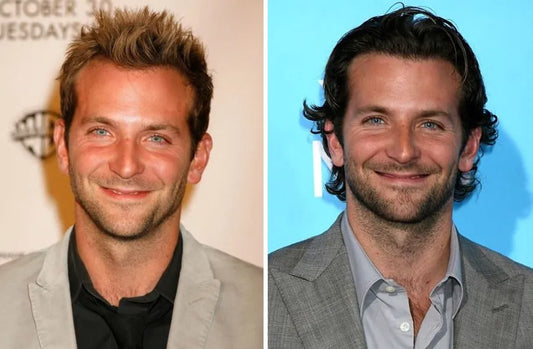 Bradley Cooper Hair Transplant