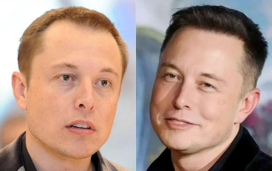 Elon Musk Hair Transplant: From PayPal to Perfect Hair