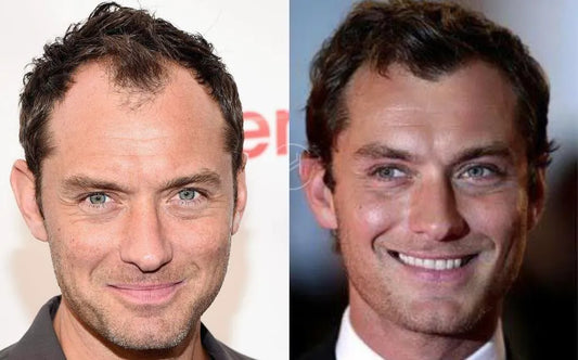 Jude Law Hair Transplant