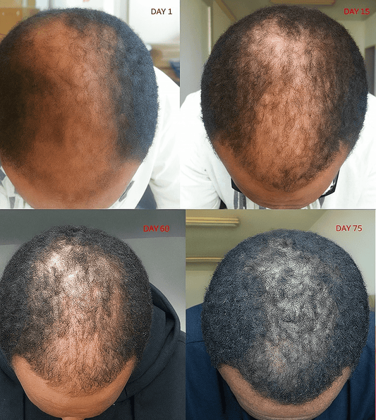 Finasteride and Dutasteride for Men: It's Not Pretty - NovaMane