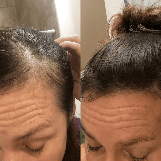 Finasteride and Dutasteride for Women: Risks & Safe Alternatives - NovaMane