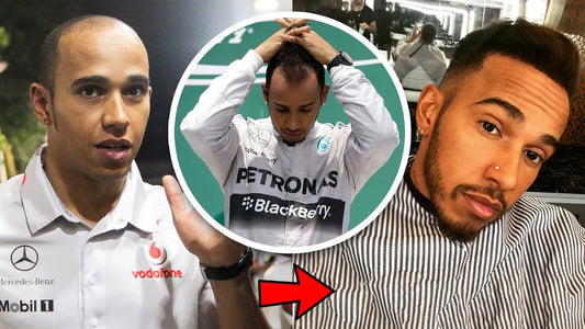 Lewis Hamilton Hair Transplant