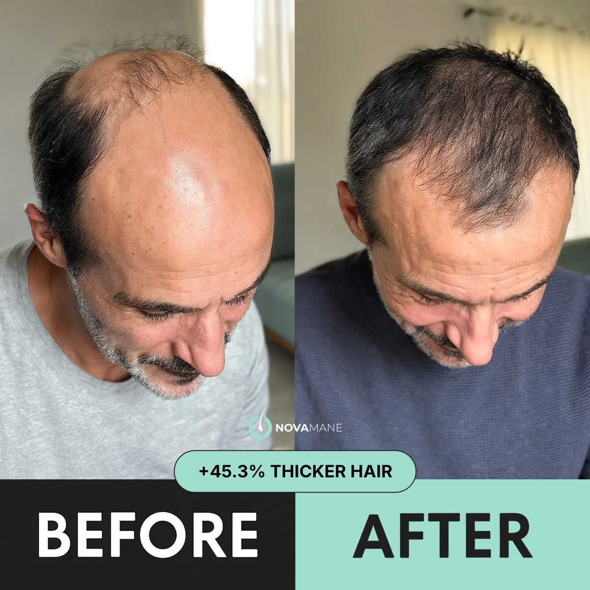 Hair Regrowth Micro - Infusion System M - NovaMane