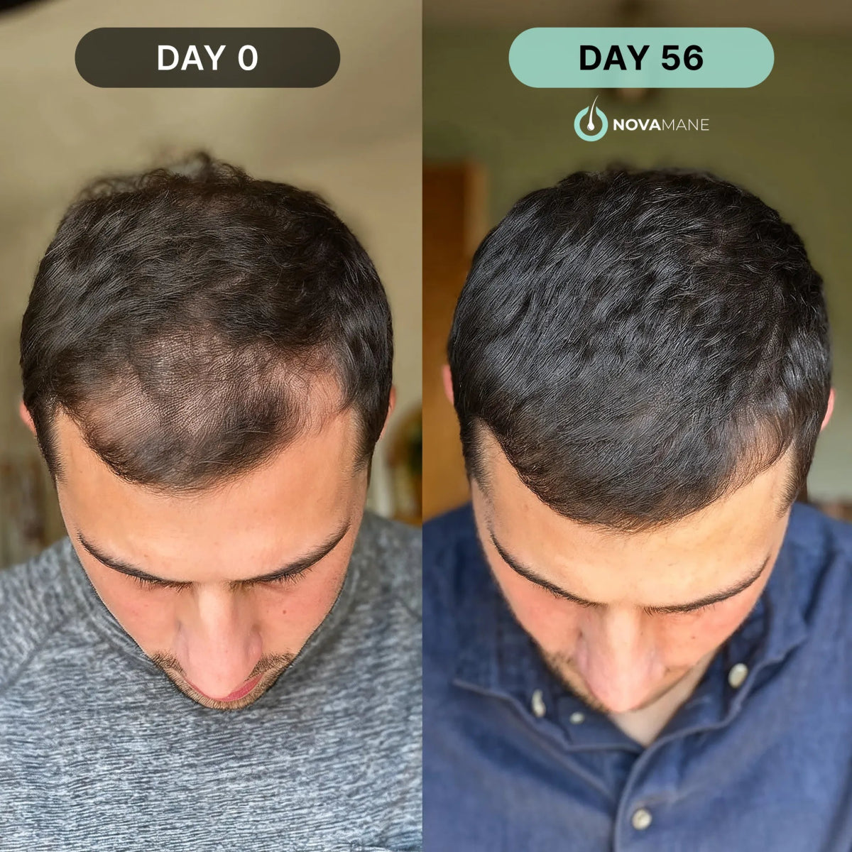 Hair Regrowth Micro - Infusion System M - NovaMane