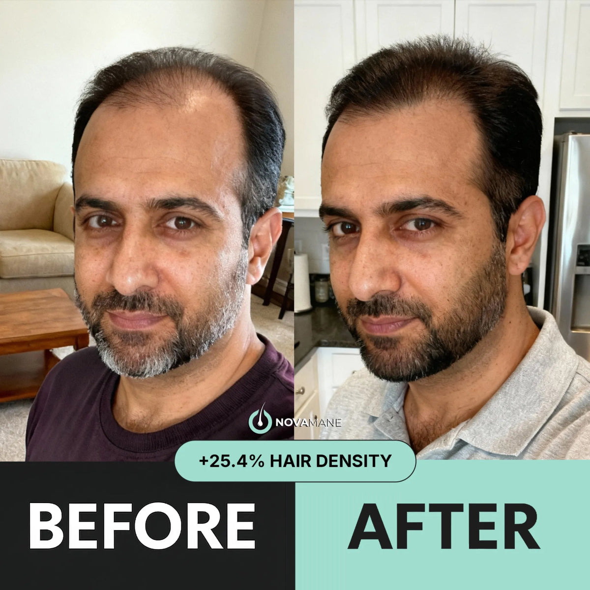 Hair Regrowth Micro - Infusion System M - NovaMane