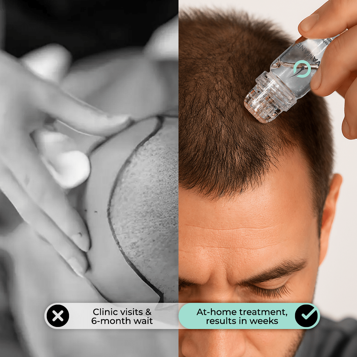 NovaMane - NovaMane Hair Regrowth Micro-Infusion System