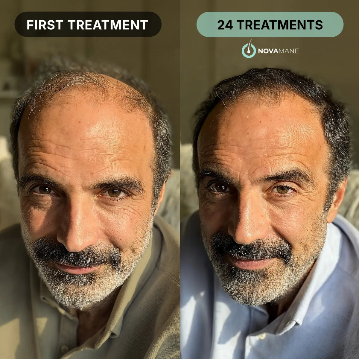 Hair Regrowth Micro - Infusion System M - NovaMane