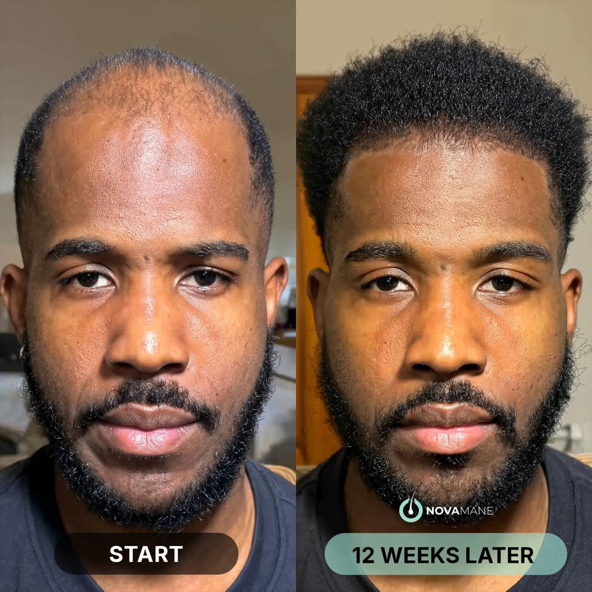 Hair Regrowth Micro - Infusion System M - NovaMane