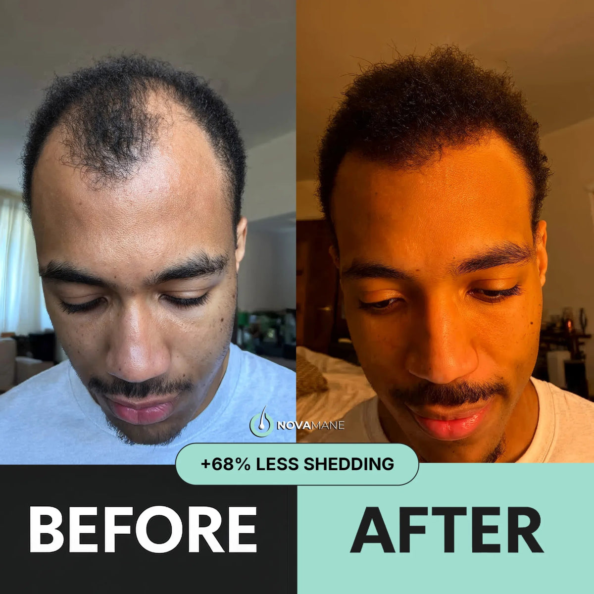 Hair Regrowth Micro - Infusion System M - NovaMane