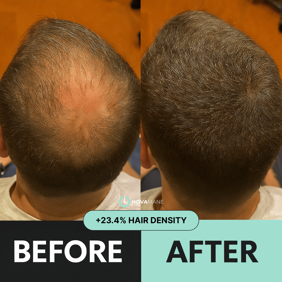 NovaMane - NovaMane Hair Regrowth Micro-Infusion System