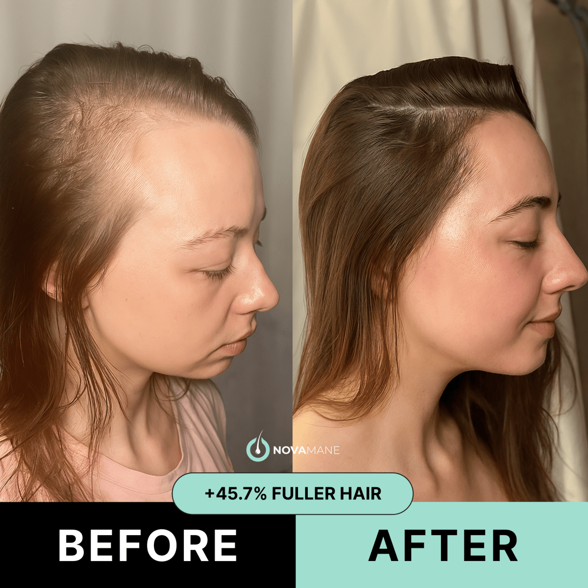NovaMane - Hair Regrowth Micro-Infusion System For Women