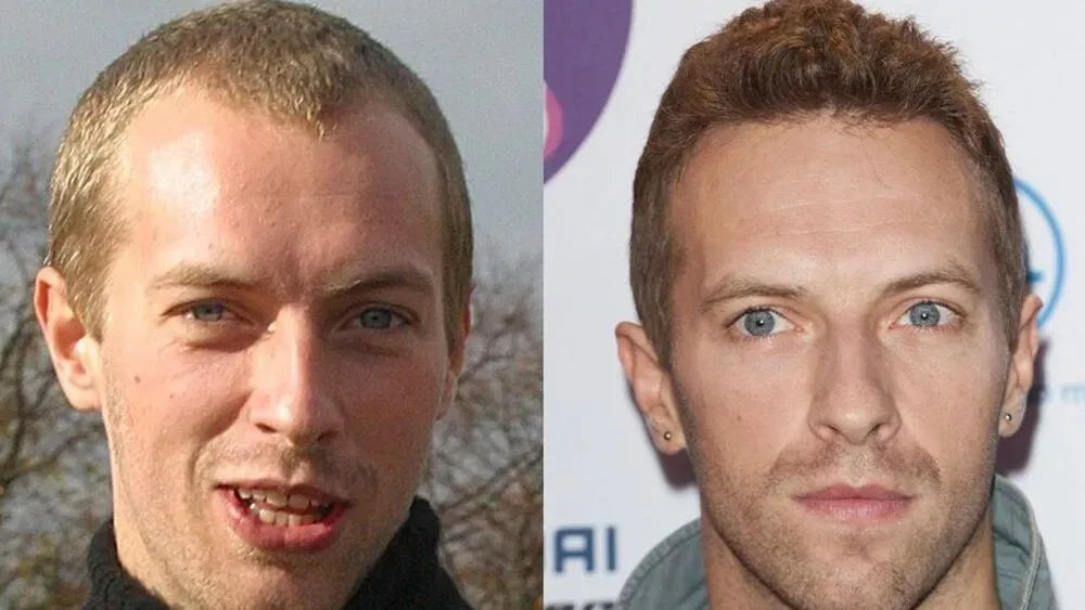 Chris Martin Hair Transplant