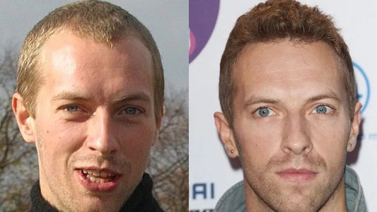 Chris Martin Hair Transplant