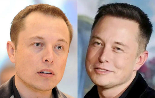 Elon Musk Hair Transplant: From PayPal to Perfect Hair - NovaMane