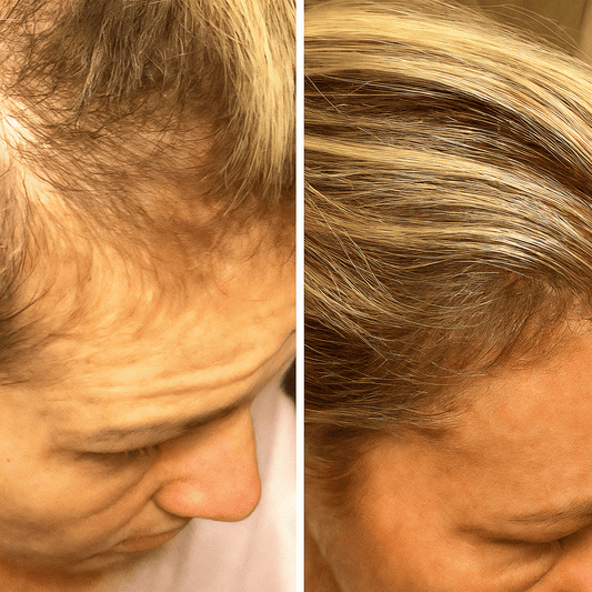 How to Stop a Receding Hairline for Women: Addressing the Hidden Causes - NovaMane