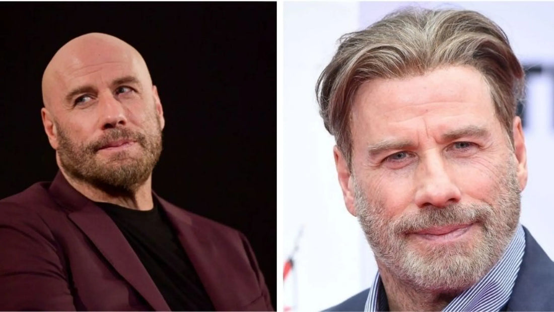 John Travolta Hair Transplant