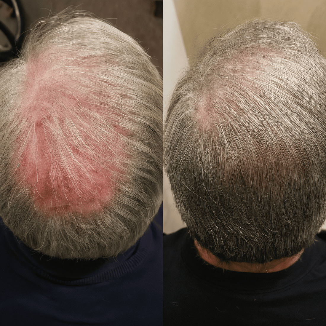 Red Light Therapy for Hair Regrowth: Does It Really Work? - NovaMane