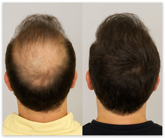 Thinning Hair Men: Early Signs, Real Causes & Scientific Solution - NovaMane