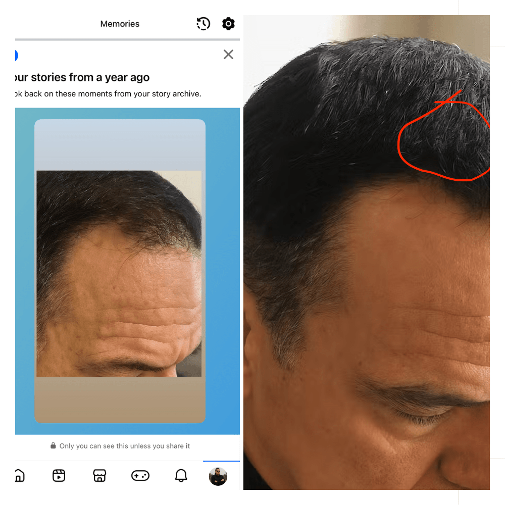 Close-up of a person's scalp with visible hairline and skin texture, showing a social media interface on the left.