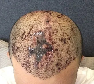 Scalp with visible lesions on a person's head against a dark background
