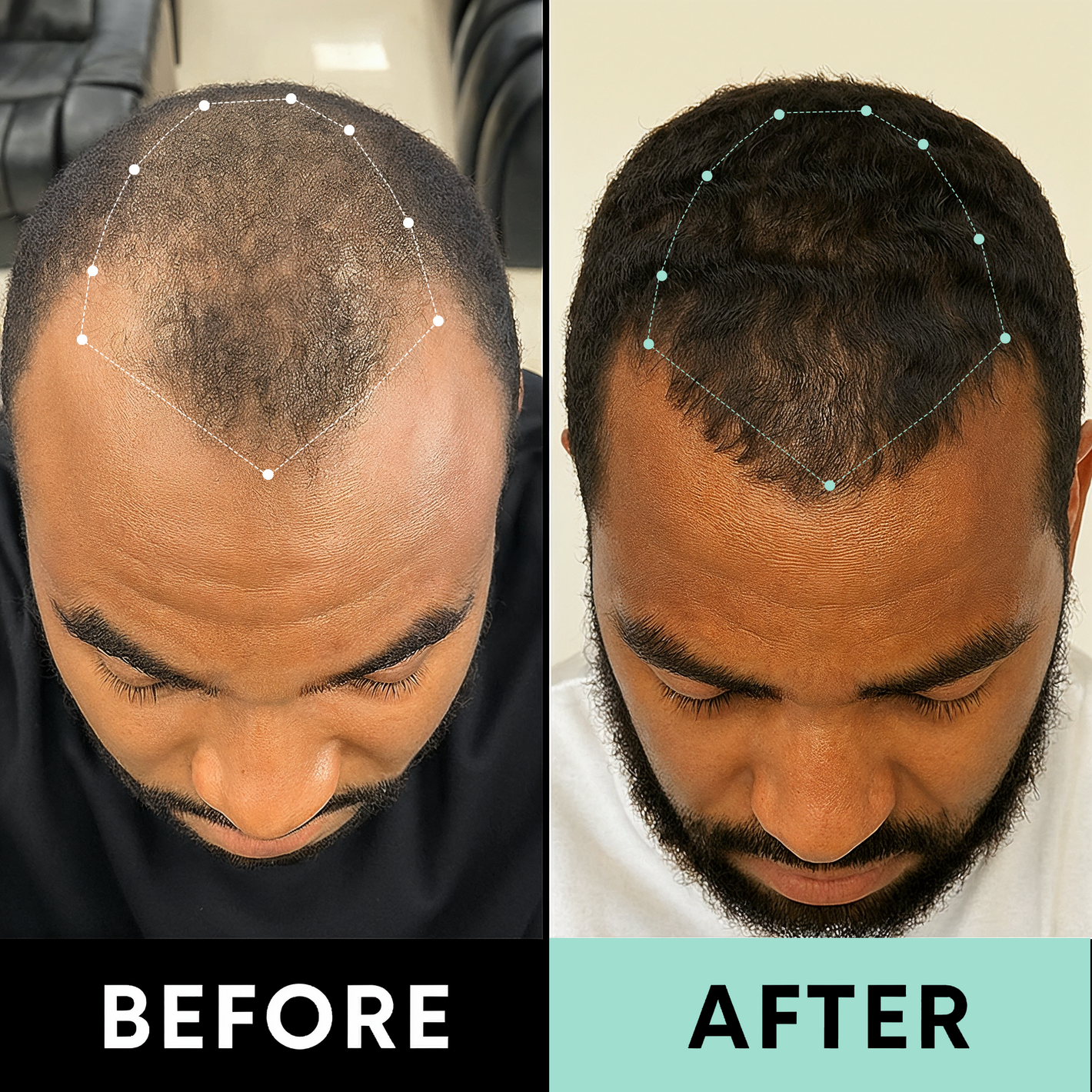 Confident Hairline