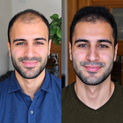 Before and after comparison of a man with hair loss and regrowth.


