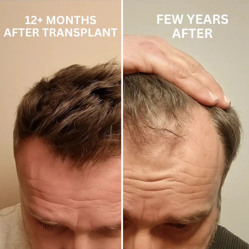 Thinning_receeding_hairline