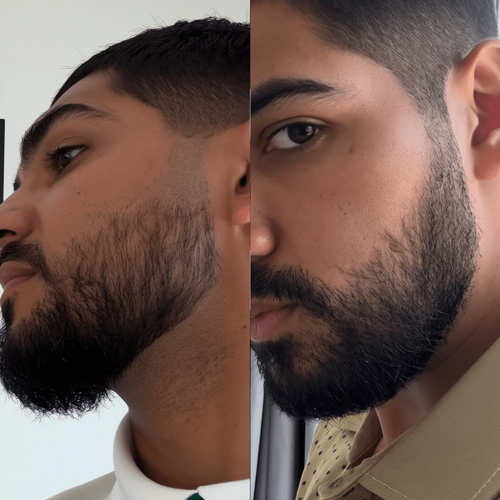 Beard Micro-Infusion System 2.0 For Thicker & Fuller Beard - NovaMane