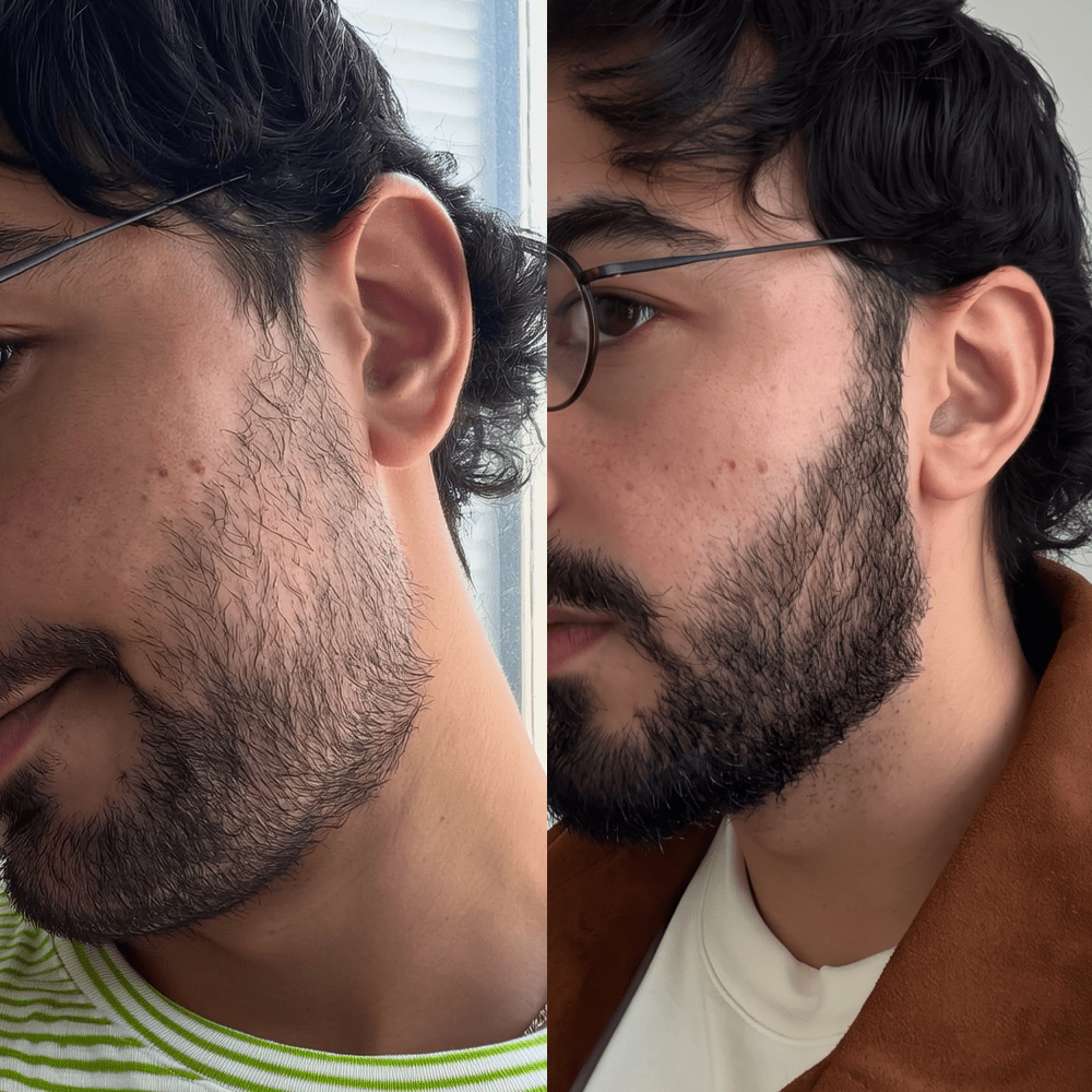 Beard Micro-Infusion System 2.0 For Thicker & Fuller Beard - NovaMane