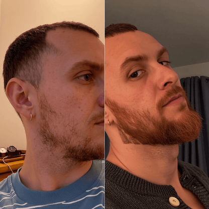 Beard Micro-Infusion System 2.0 For Thicker & Fuller Beard - NovaMane