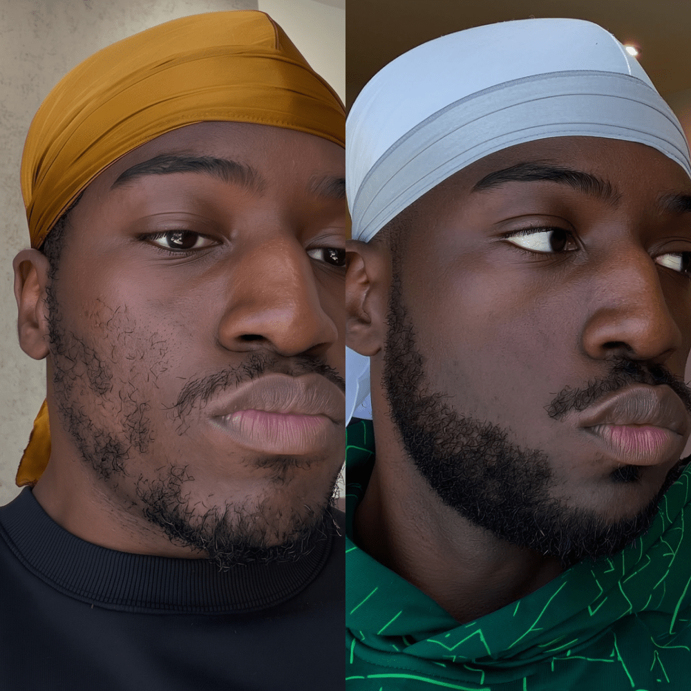 Beard Micro-Infusion System 2.0 For Thicker & Fuller Beard - NovaMane