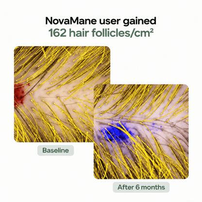 Beard Micro-Infusion System 2.0 For Thicker & Fuller Beard - NovaMane