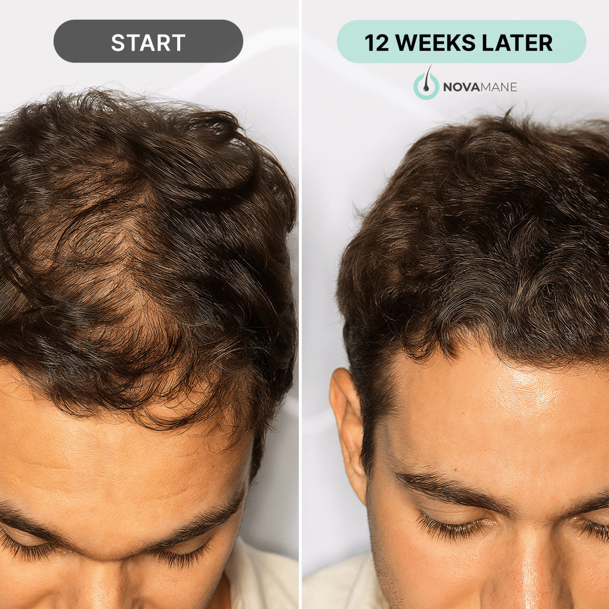 NovaMane - NovaMane Hair Regrowth Micro-Infusion System
