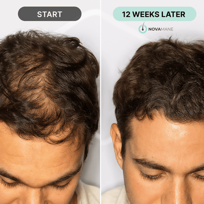 NovaMane - NovaMane Hair Regrowth Micro-Infusion System