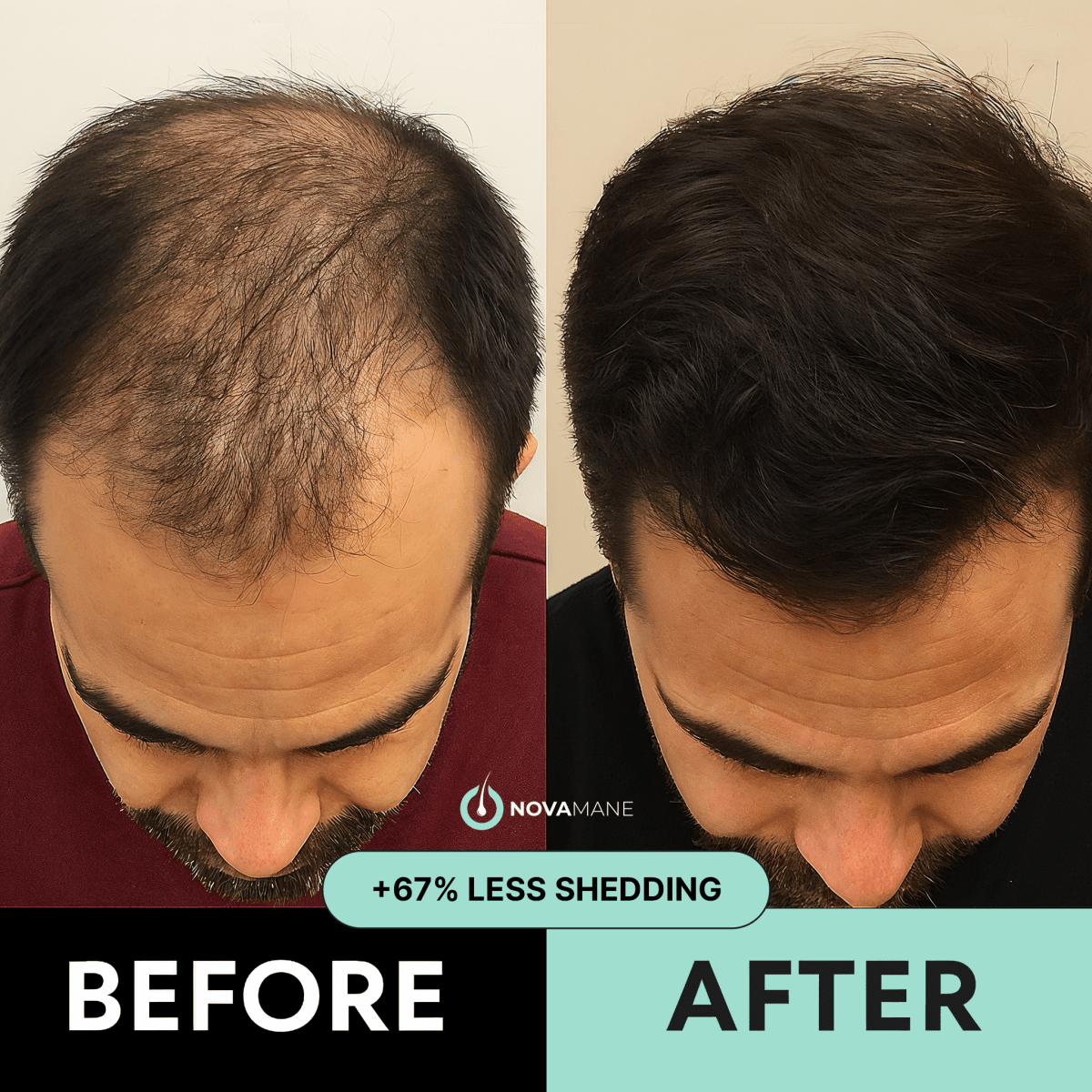 NovaMane - NovaMane Hair Regrowth Micro-Infusion System