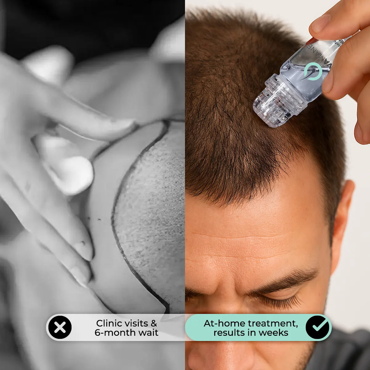 adenosine and ghk-cu micro-infusion system NovaMane