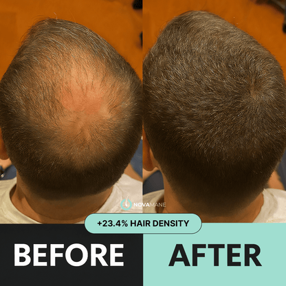 NovaMane - NovaMane Hair Regrowth Micro-Infusion System