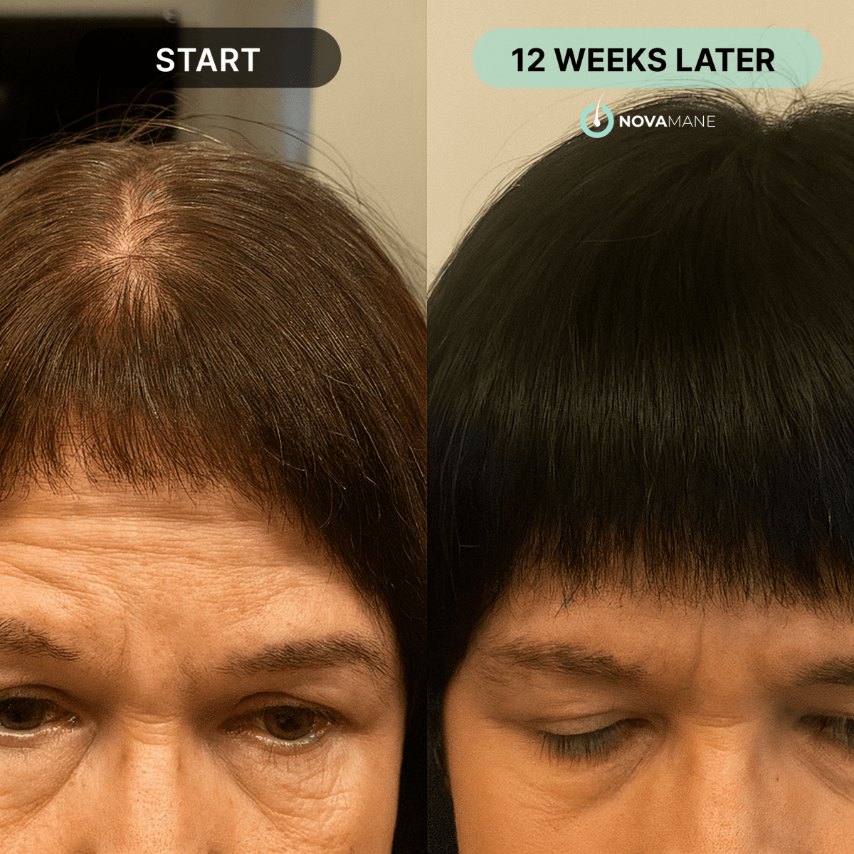 NovaMane - Hair Regrowth Micro-Infusion System For Women