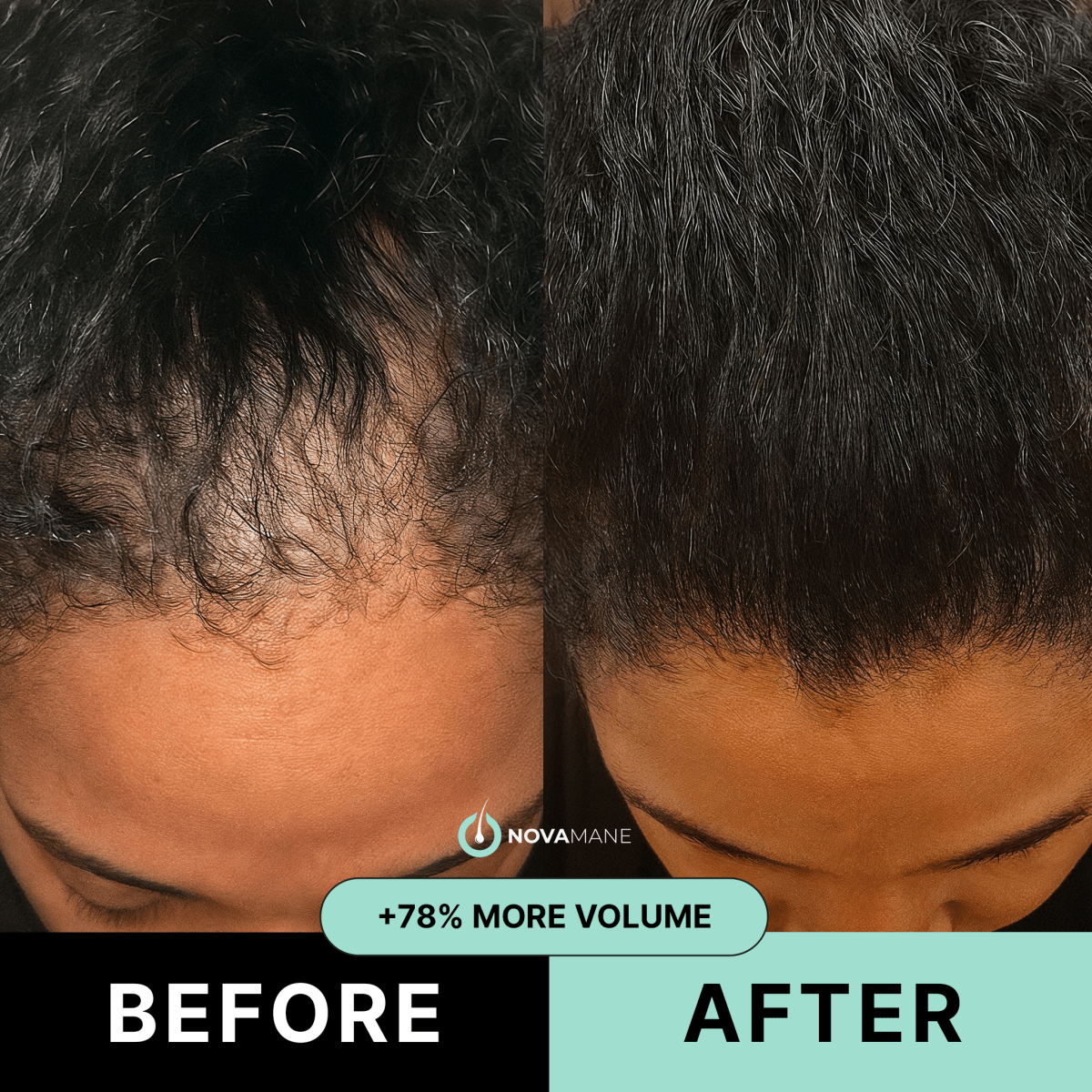 NovaMane - Hair Regrowth Micro-Infusion System For Women