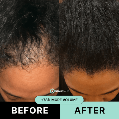 NovaMane - Hair Regrowth Micro-Infusion System For Women