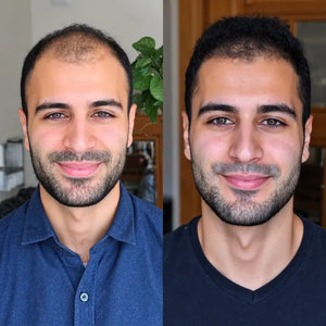 Thicker, Fuller Hairline