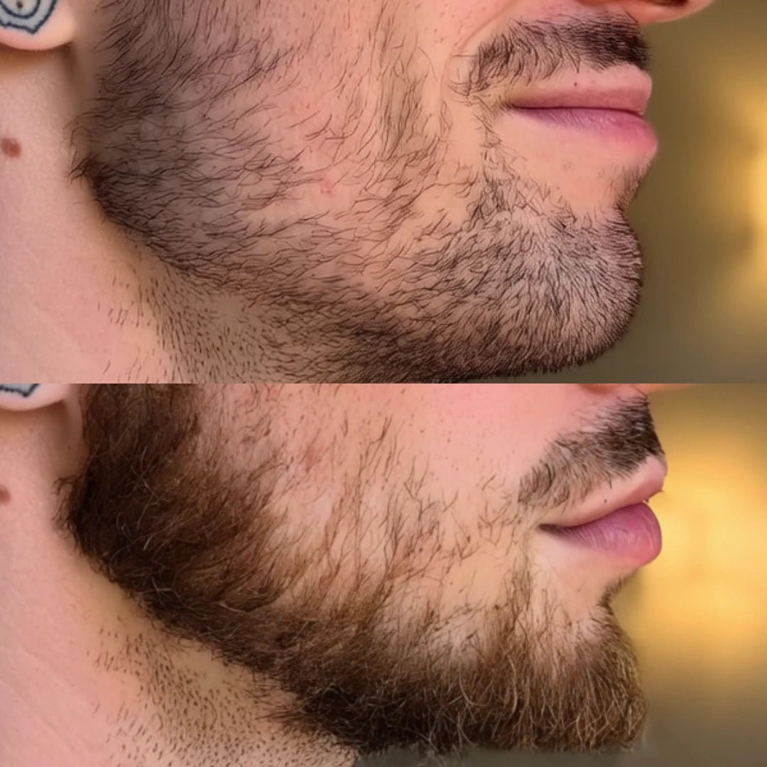 NovaMane Hair Regrowth Micro - Infusion System For Beards - NovaMane