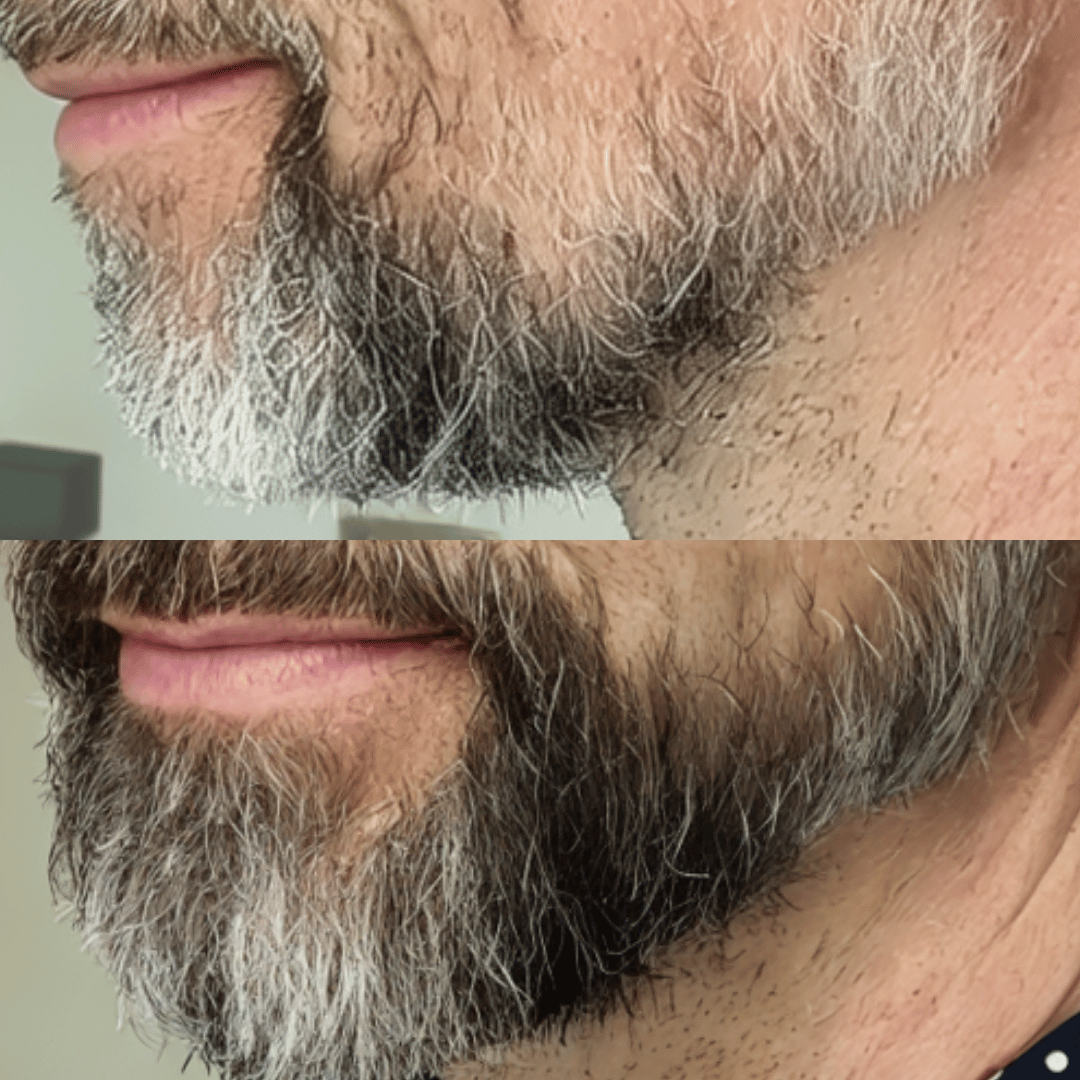 NovaMane Hair Regrowth Micro - Infusion System For Beards - NovaMane