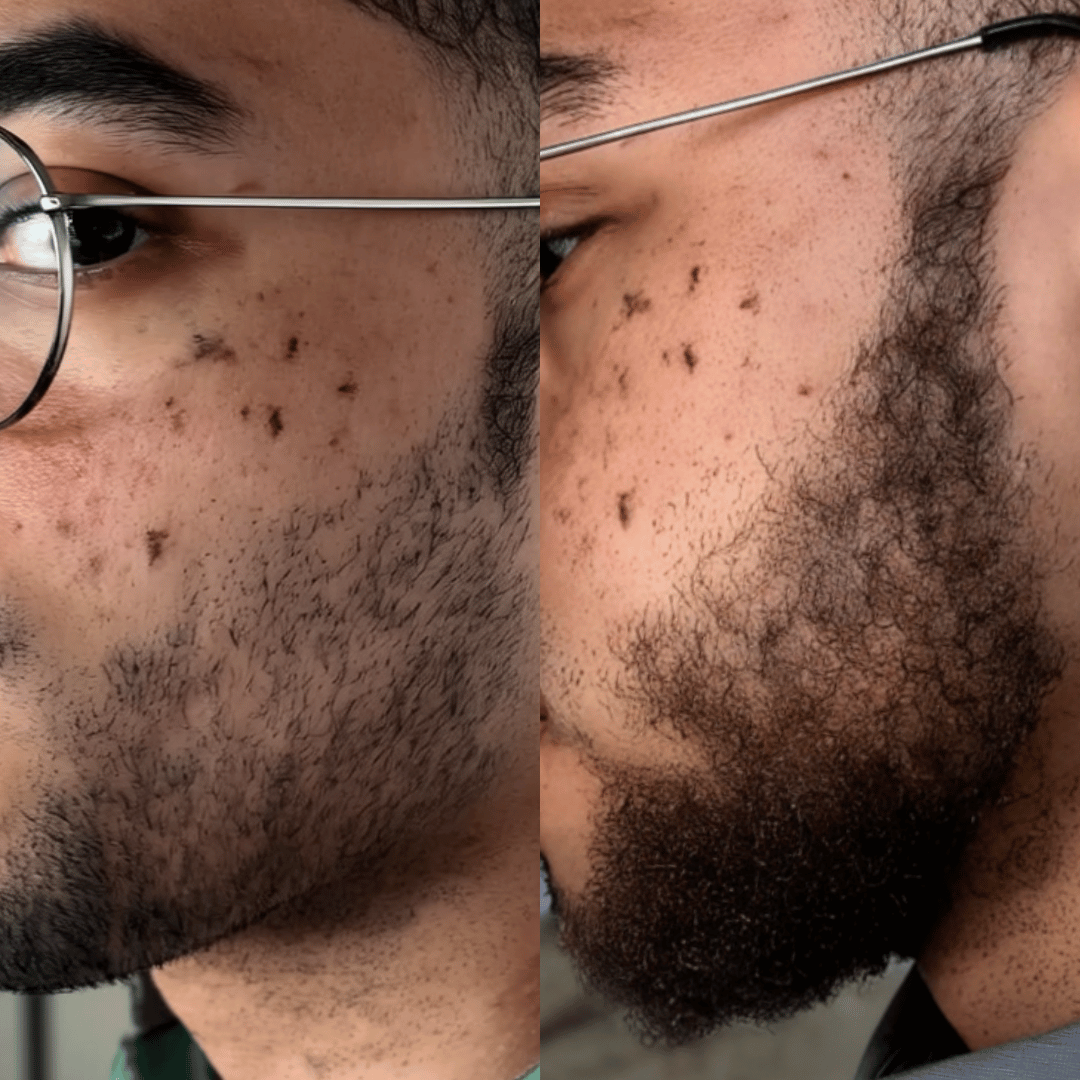 NovaMane Hair Regrowth Micro - Infusion System For Beards - NovaMane