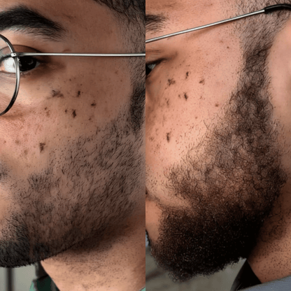 NovaMane Hair Regrowth Micro - Infusion System For Beards - NovaMane