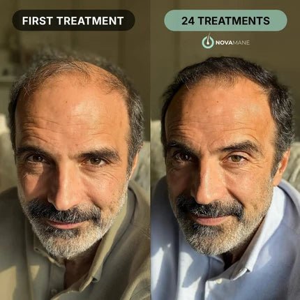 NovaMane Hair Regrowth Micro-Infusion System For Men - NovaMane