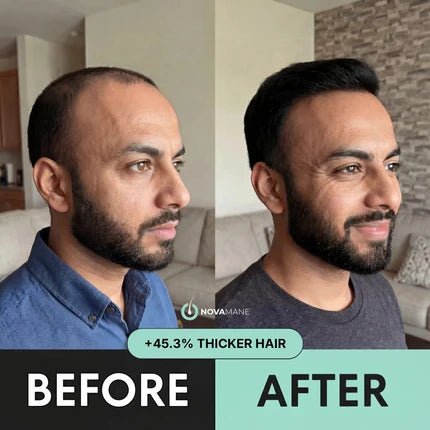 NovaMane Hair Regrowth Micro-Infusion System For Men - NovaMane