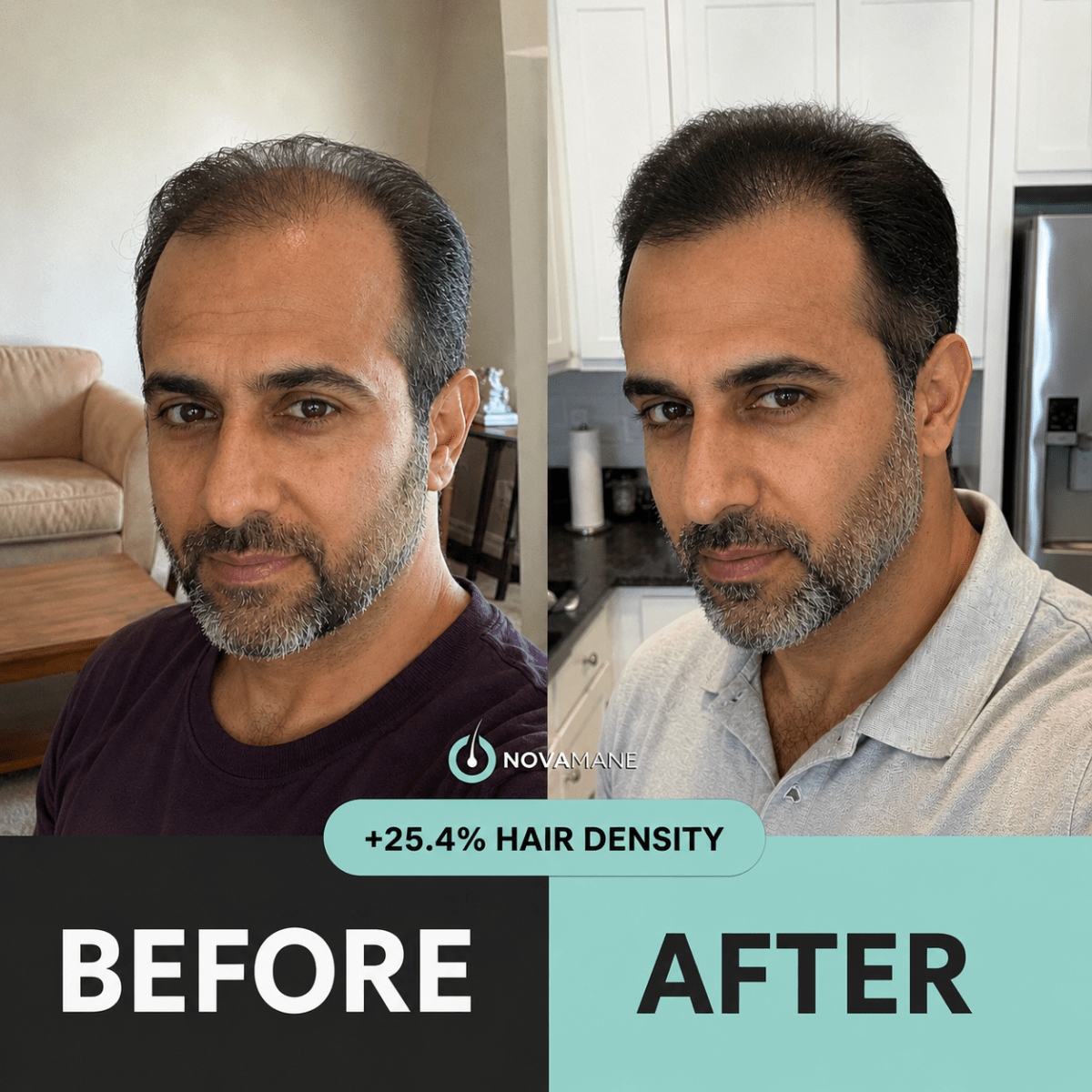 NovaMane Hair Regrowth Micro-Infusion System For Men (TRT) - NovaMane