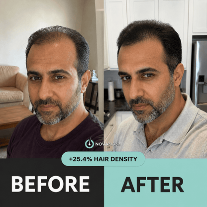 NovaMane Hair Regrowth Micro-Infusion System For Men (TRT) - NovaMane