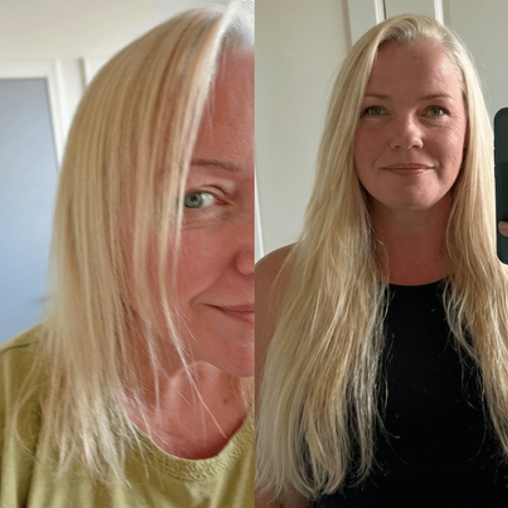 NovaMane Hair Regrowth Micro-Infusion System For Women - NovaMane